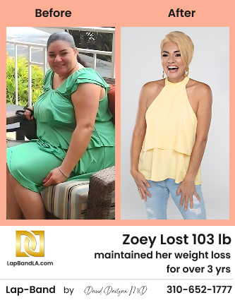 Zoey-Before-After