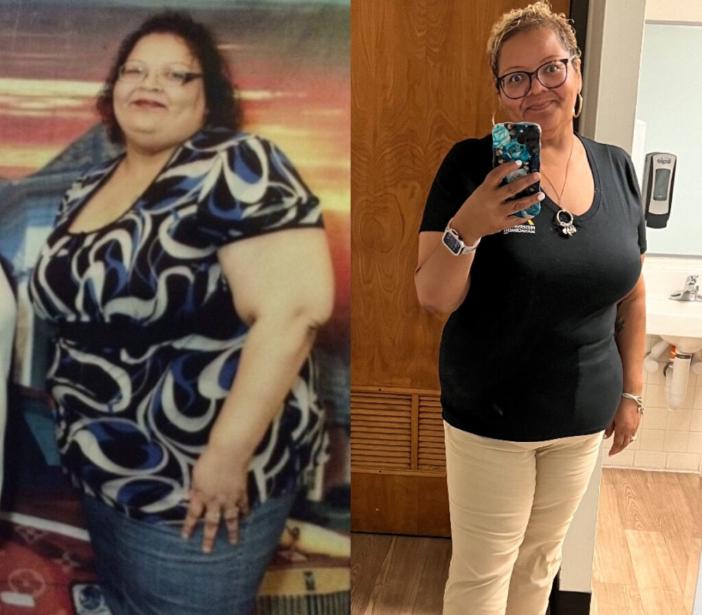 Cylvia H 111s-lb weight loss with Lap-Band by John Olsofka, MD, FACS