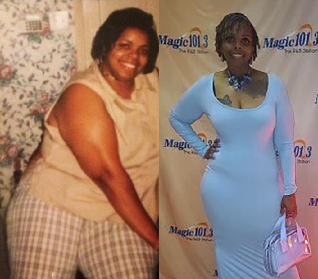 Edith C 147s-lb weight loss with Lap-Band by John Olsofka, MD, FACS