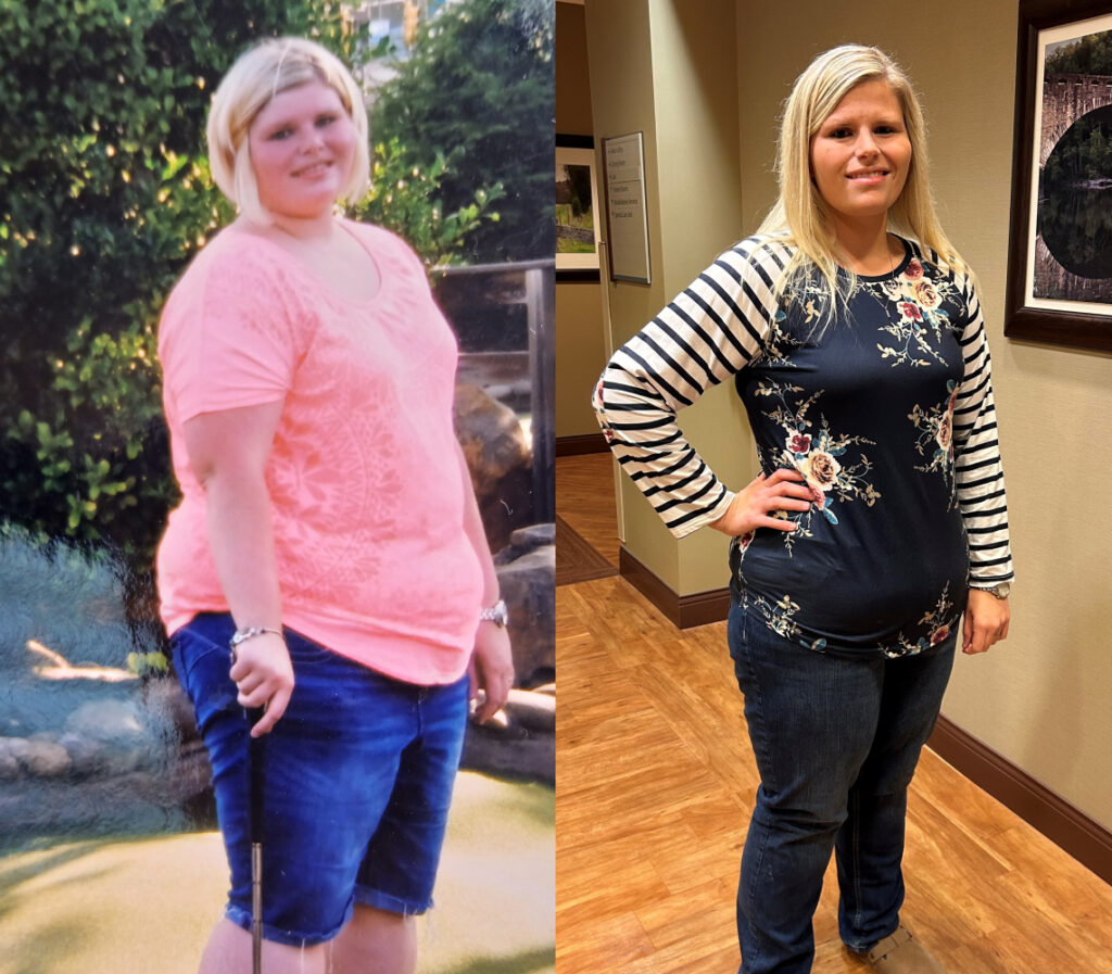 Stacia F 76s-lb weight loss with Lap-Band by John C. Mobley, MD, FACS