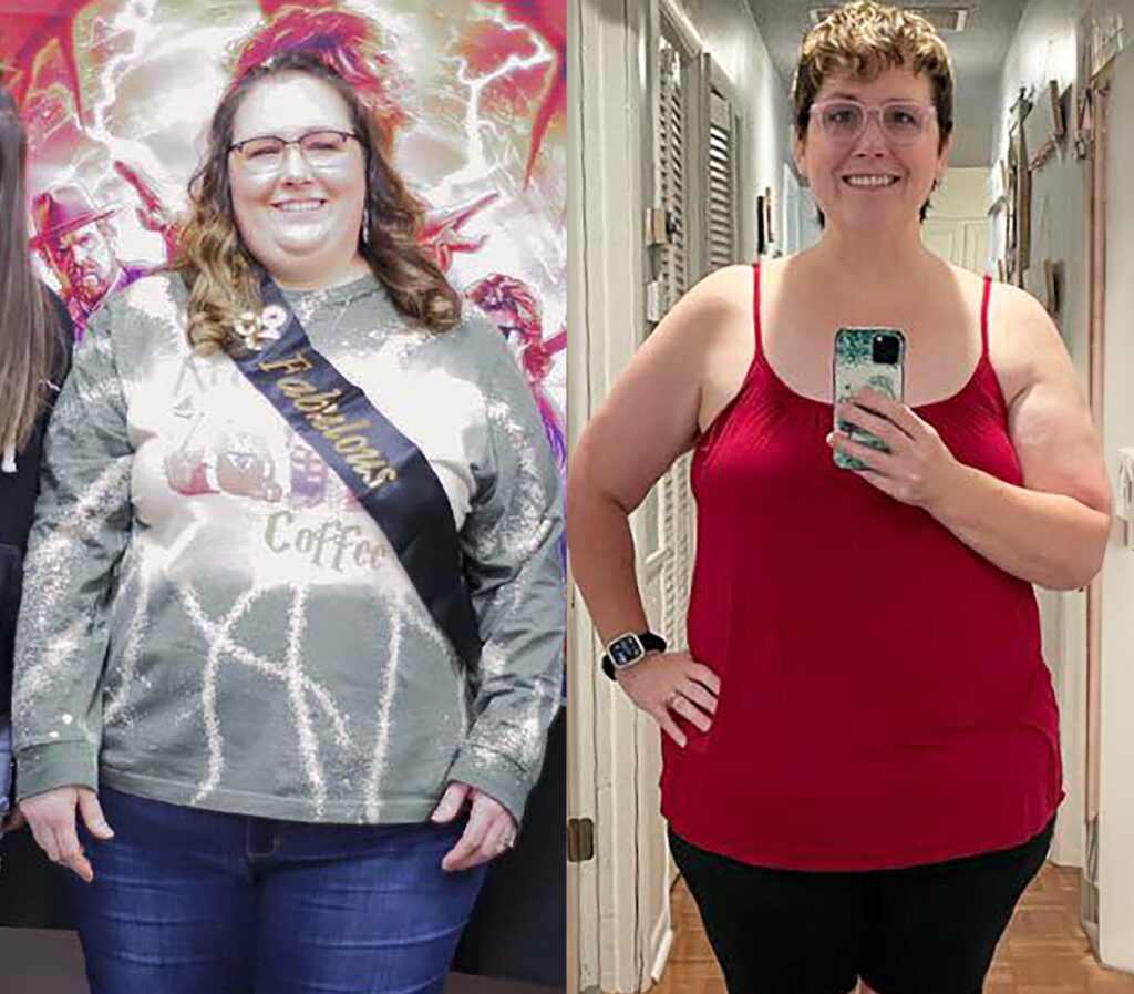 Tami L 76s-lb weight loss with Lap-Band by Sid Rohrscheib, MD