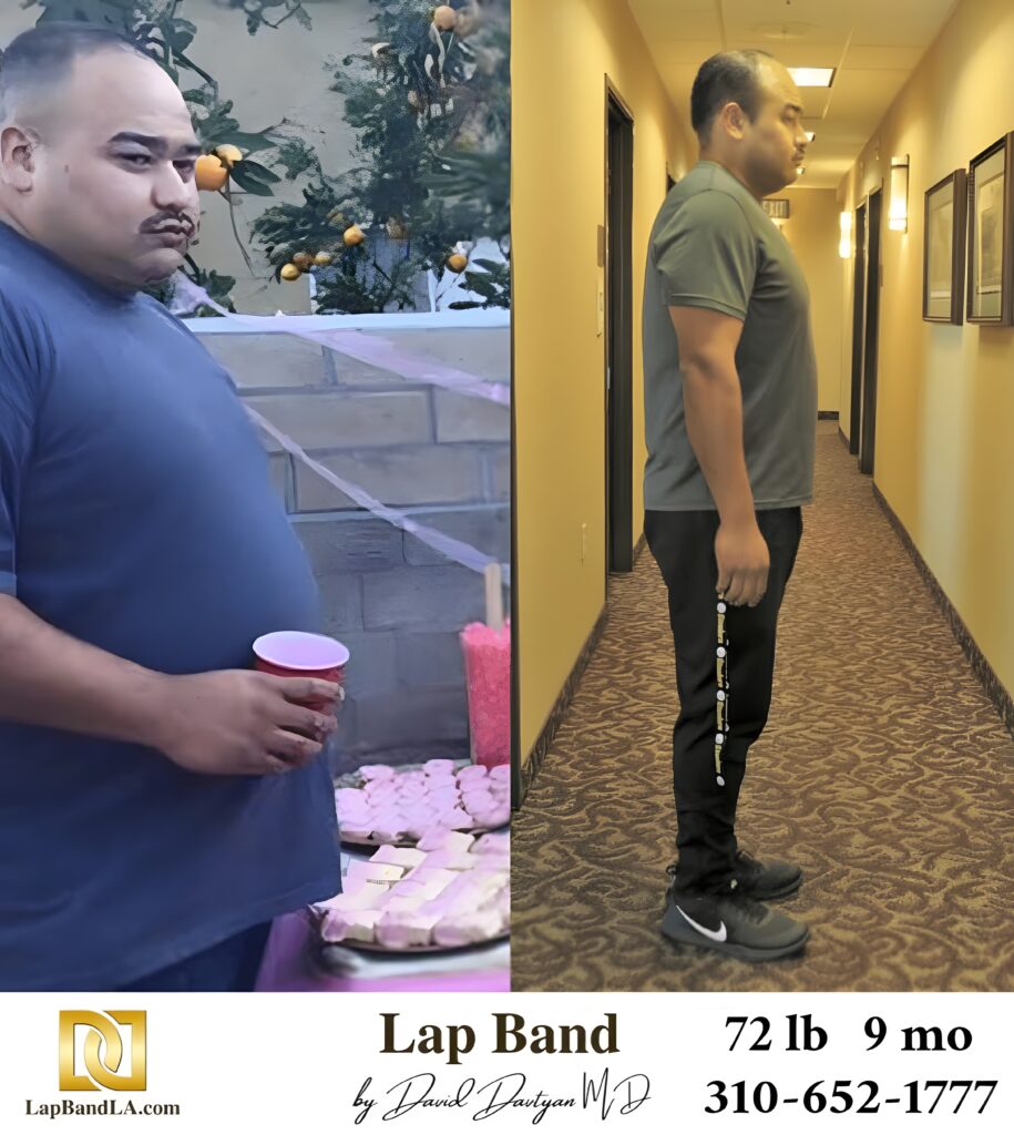 Abe 72s-lb weight loss with Lap-Band by David G. Davtyan MD, FACS, FICS