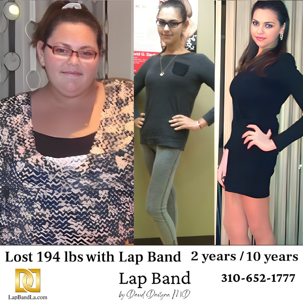 Aleksandra Tukan 194s-lb weight loss with Lap-Band by David G. Davtyan MD, FACS, FICS