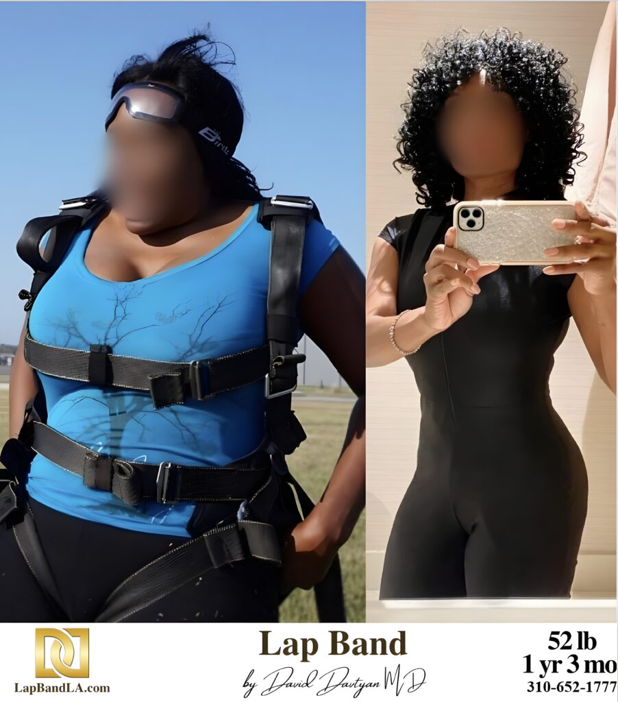 April 52s-lb weight loss with Lap-Band by David G. Davtyan MD, FACS, FICS