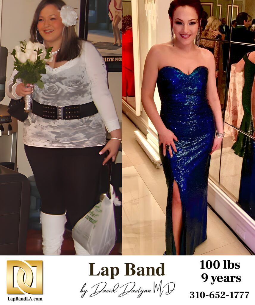 Briyana Batsian 100s-lb weight loss with Lap-Band by David G. Davtyan MD, FACS, FICS