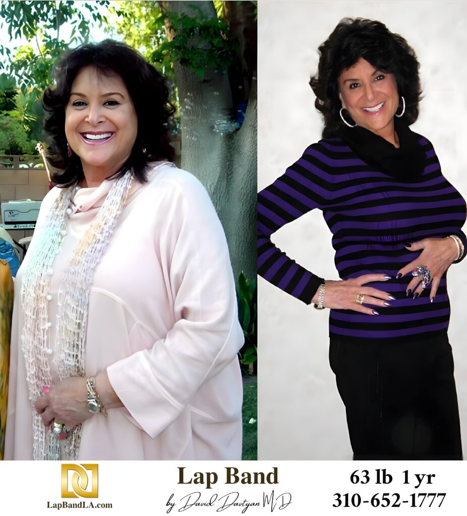 Candice M 63s-lb weight loss with Lap-Band by David G. Davtyan MD, FACS, FICS