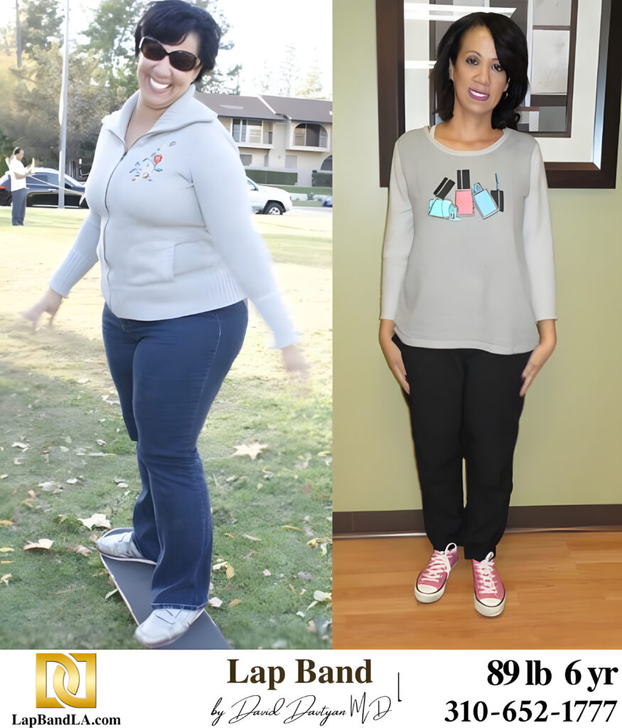 Cardenas Mayra 89s-lb weight loss with Lap-Band by David G. Davtyan MD, FACS, FICS