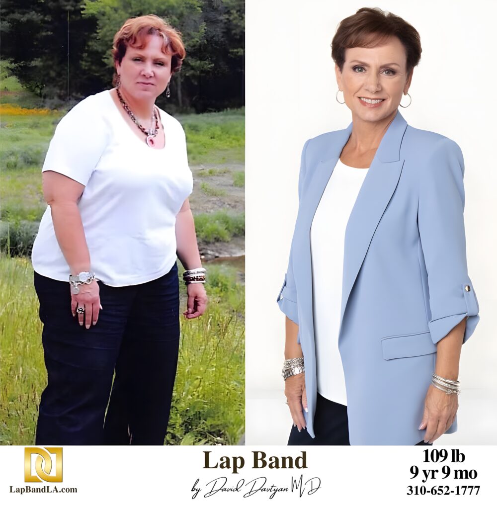 Debra 109s-lb weight loss with Lap-Band by David G. Davtyan MD, FACS, FICS