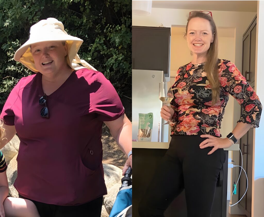 Fiona Duncan 100s-lb weight loss with Lap-Band by David G. Davtyan MD, FACS, FICS