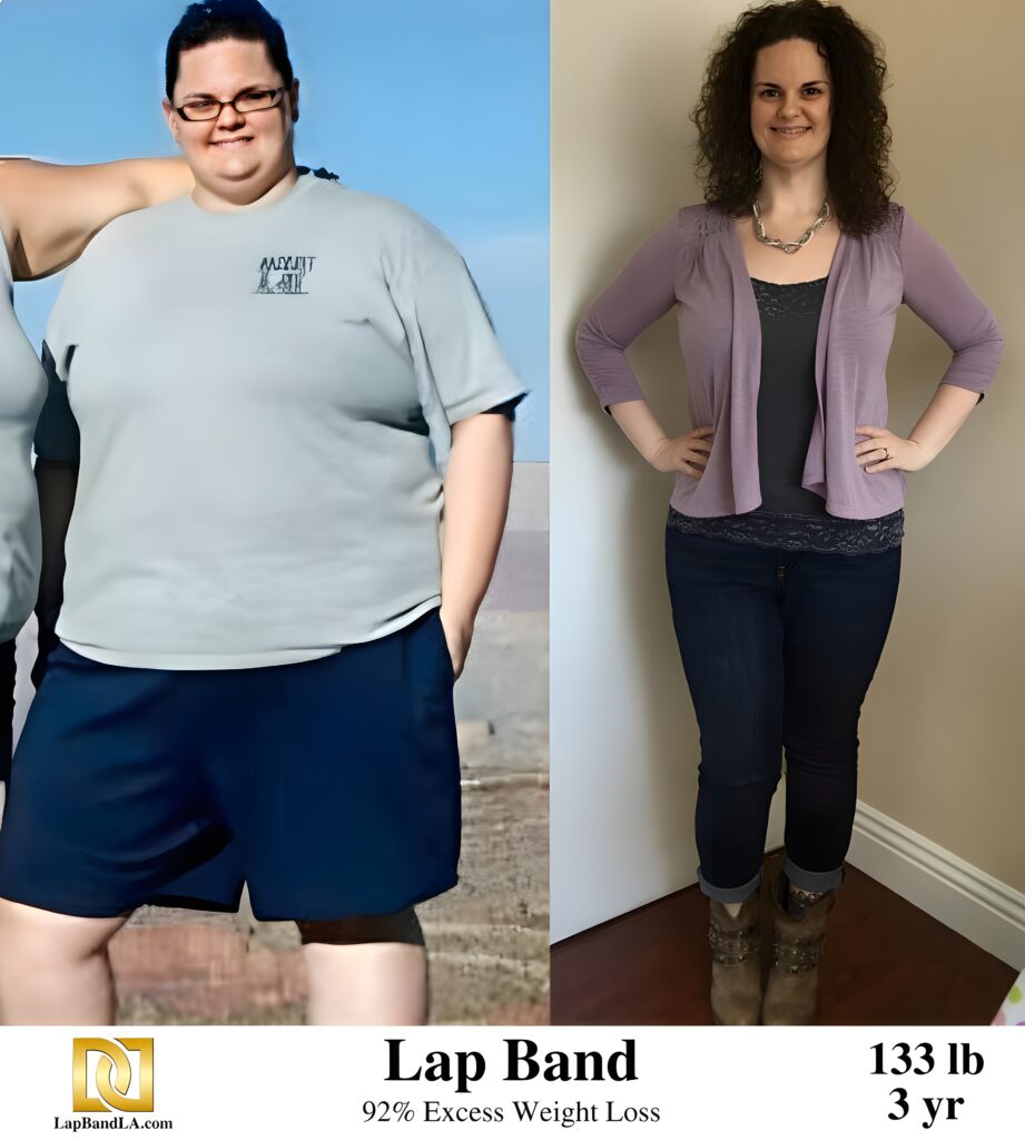 Mary Miclat 133s-lb weight loss with Lap-Band by David G. Davtyan MD, FACS, FICS