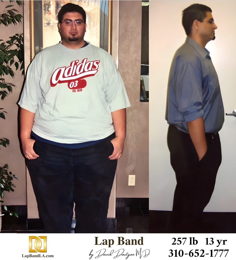 Nick 257s-lb weight loss with Lap-Band by David G. Davtyan MD, FACS, FICS