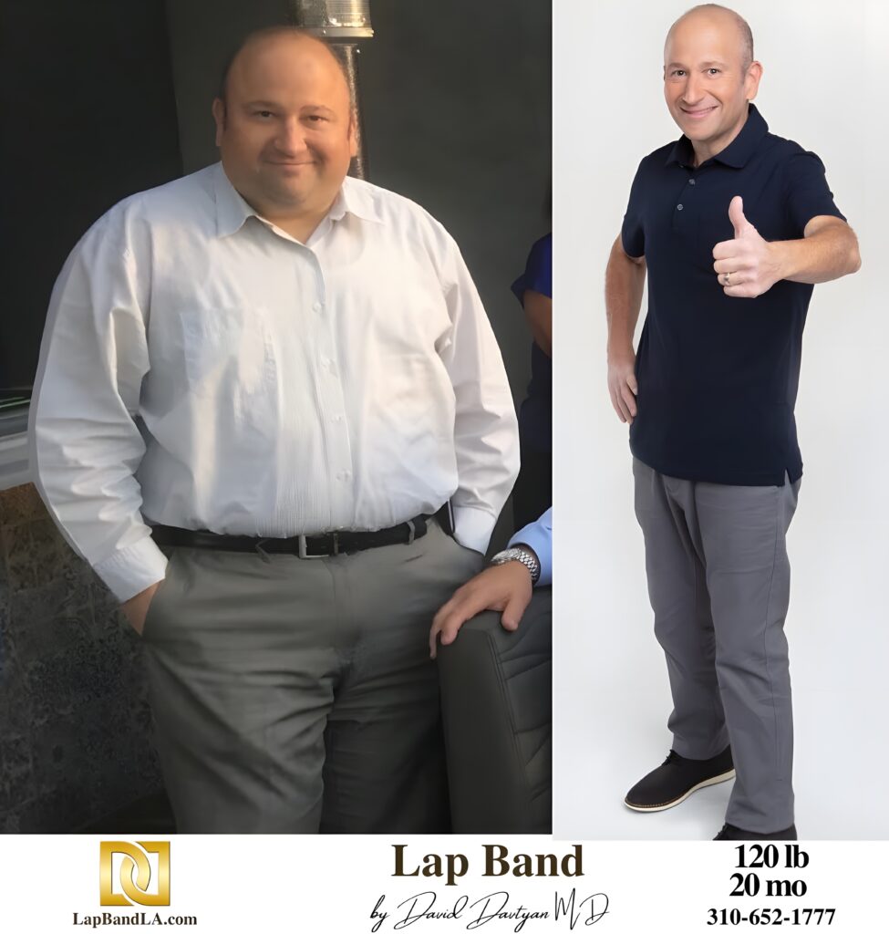 Onnig Boulanikian 120s-lb weight loss with Lap-Band by David G. Davtyan MD, FACS, FICS