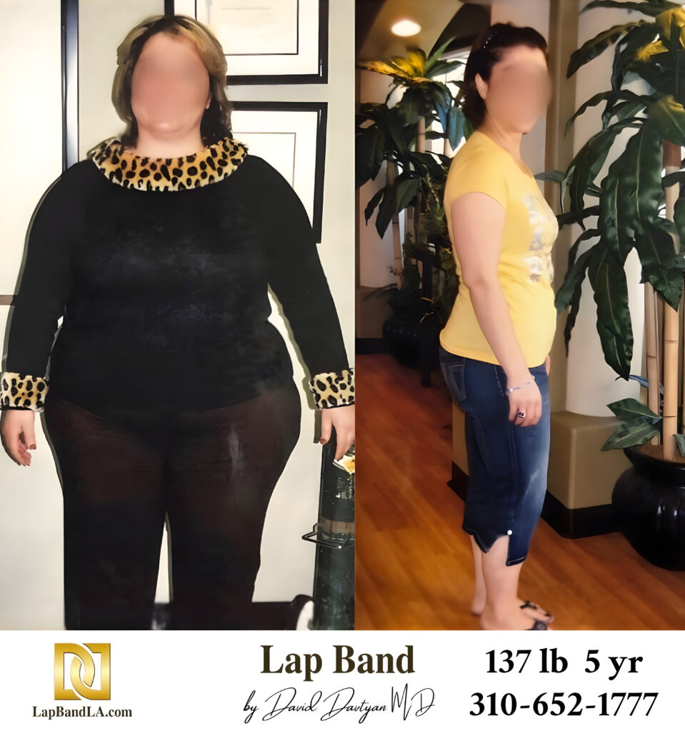 Rima S 137s-lb weight loss with Lap-Band by David G. Davtyan MD, FACS, FICS
