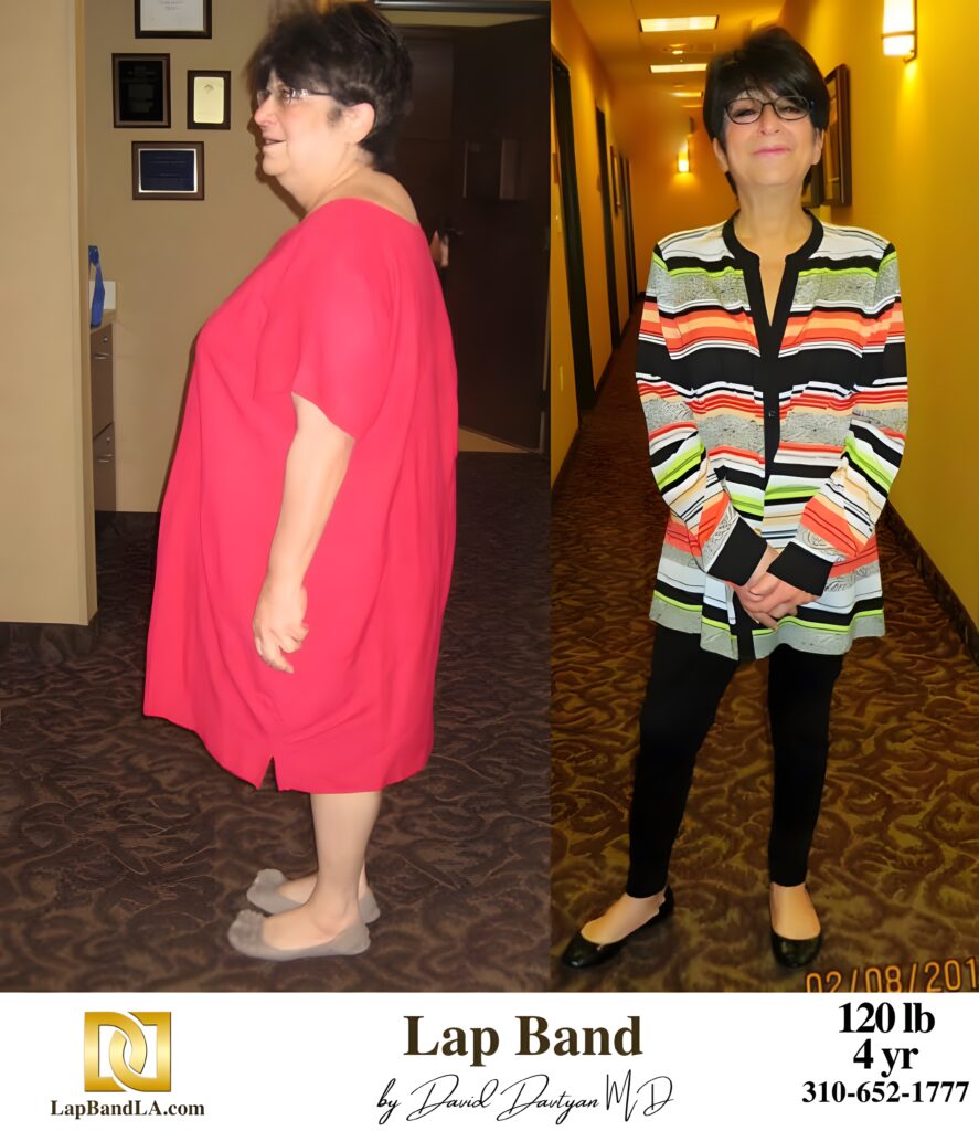 Stephanie F 120s-lb weight loss with Lap-Band by David G. Davtyan MD, FACS, FICS