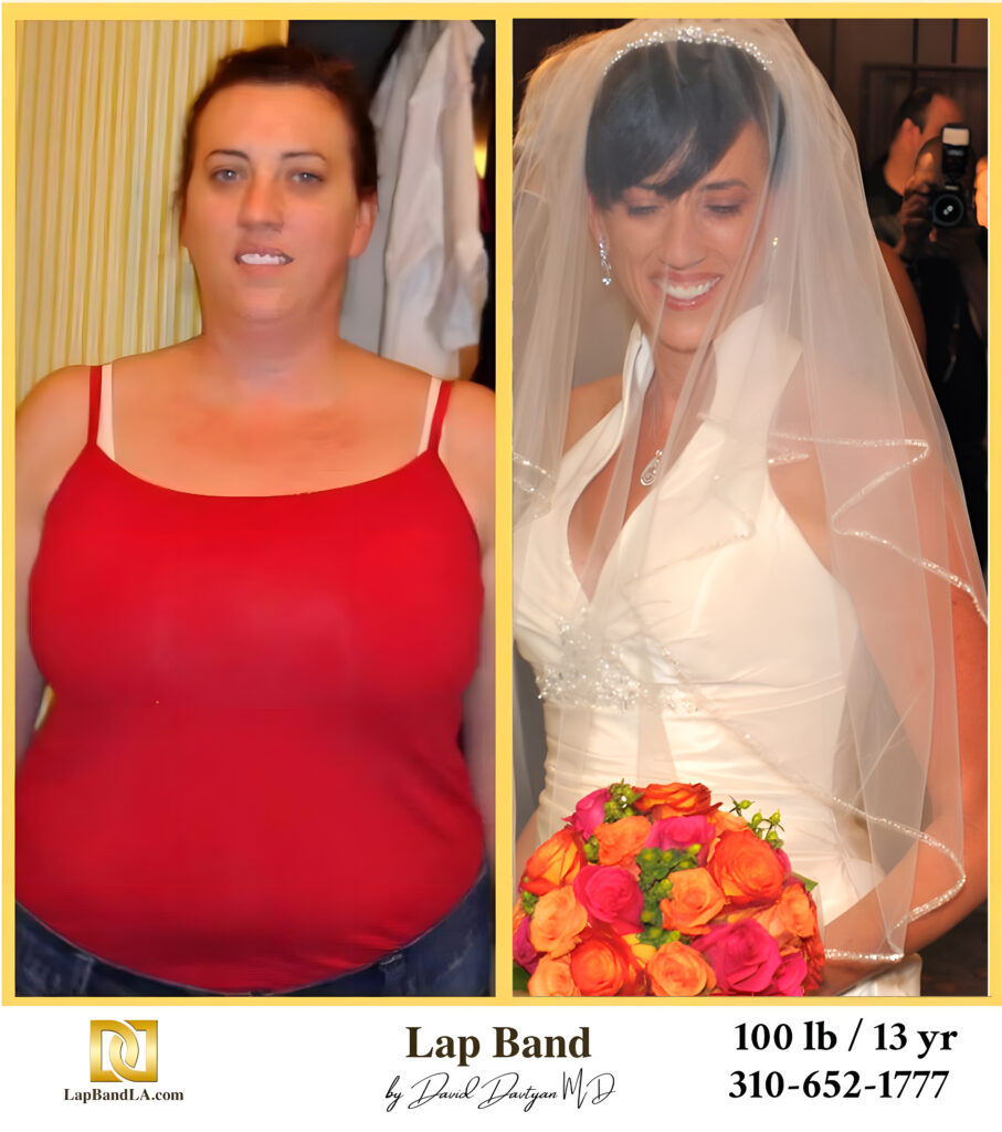 Wendy 100s-lb weight loss with Lap-Band by David G. Davtyan MD, FACS, FICS