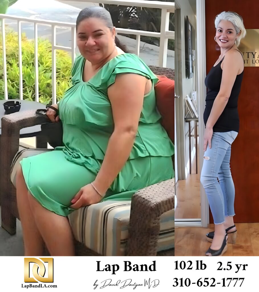 Zoey Dzovag 102s-lb weight loss with Lap-Band by David G. Davtyan MD, FACS, FICS