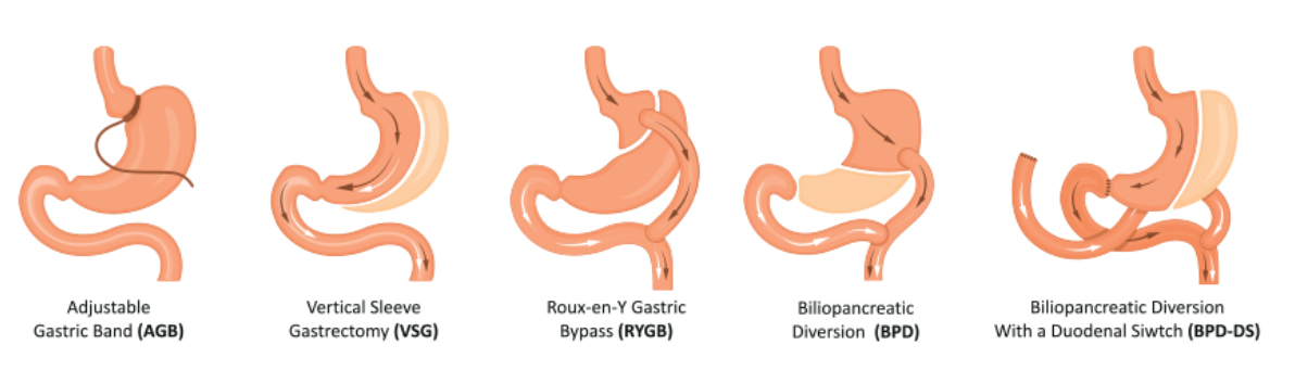 Adjustable vs Non-Adjustable Bariatric Procedures: Understanding the Difference 